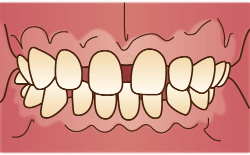 空隙歯列（くうげきしれつ）：空きっ歯