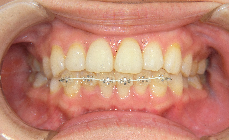 歯の裏側や透明な装置で目立ちにくい矯正治療もあります。