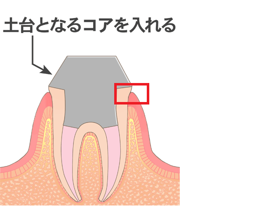 歯を残したい。抜歯したくない。その歯、残せる可能性があります。