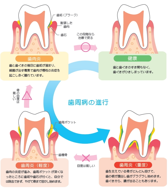 歯を失ってからでは遅い！！歯周病の怖さと、治療・予防について