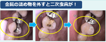 セラミックは白くて見た目が良いだけではありません！