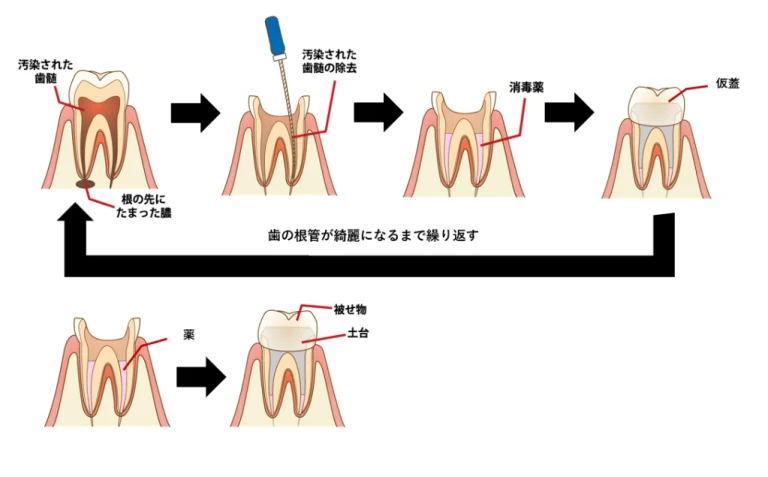 根管治療